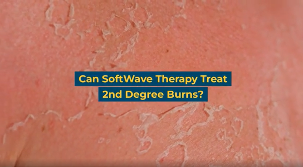 Can SoftWave Therapy Help Treat 2nd-Degree Burns?