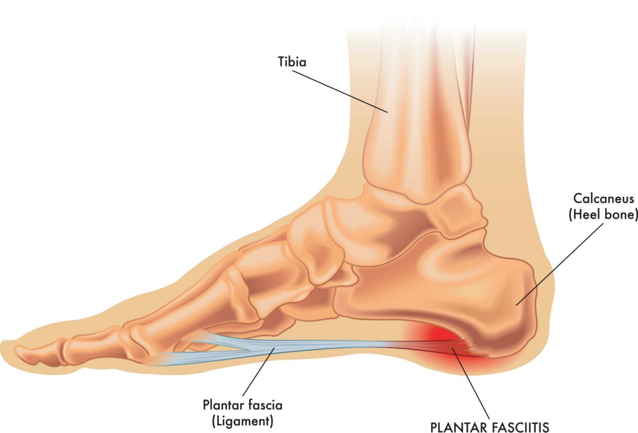 Understanding Plantar Fasciitis